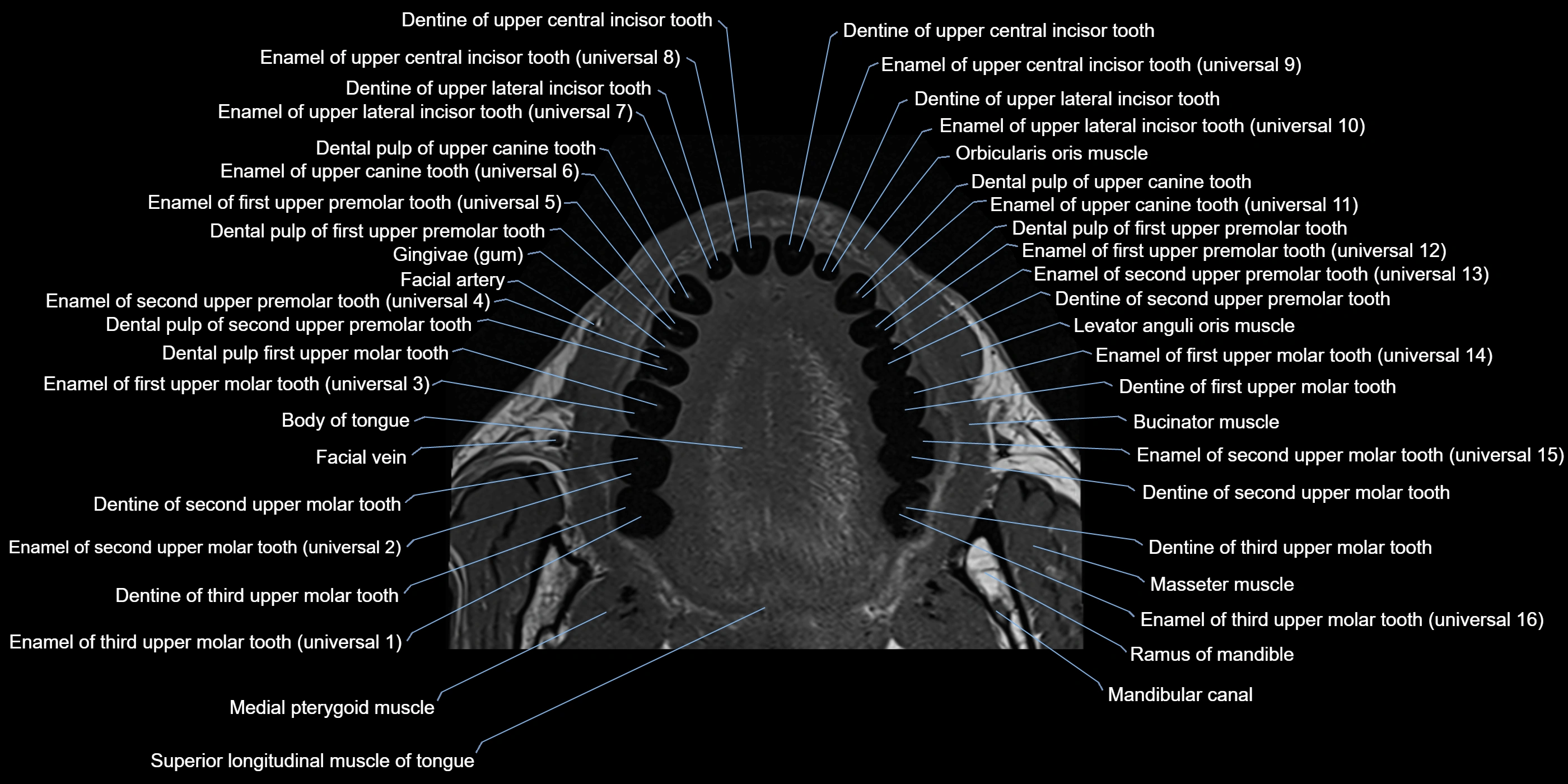 Dental MRI( tooth) axial labelled  cross sectional 3T anatomy -img-00007.webp